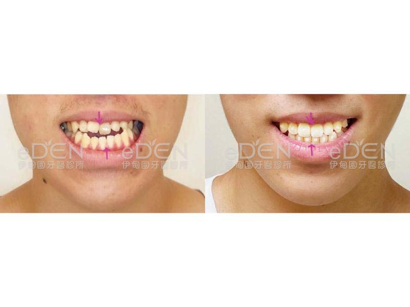 骨性問題免開刀免骨釘免鋼架