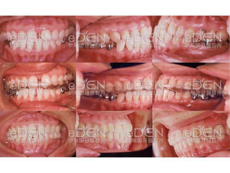 臉歪+顳顎關節症狀