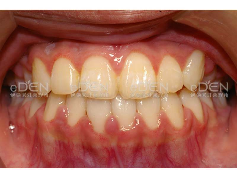 隱形矯正(咬合不正)