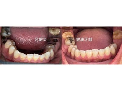 牙周病治療案例
